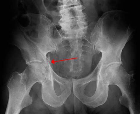 acetabulum fracture